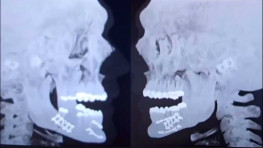 Джейку Полу удалили зубы и установили титановые пластины на сломанную челюсть
