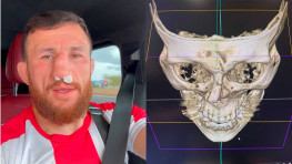 Мераб Двалишвили получил перелом носа во время спарринга, отказался от операции