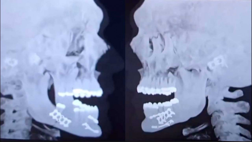 Джейку Полу удалили зубы и установили титановые пластины на сломанную челюсть
